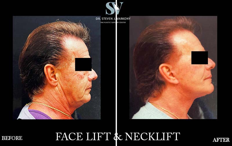 FaceLift and Neck lift before and after
