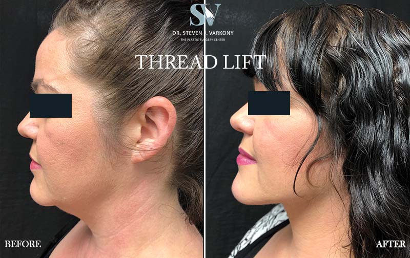 non surgical Threadlift before and after