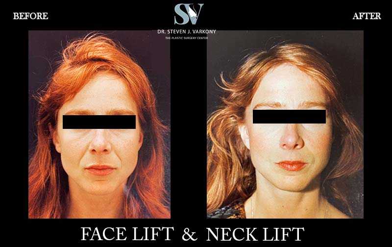 facelift and neck lift before and after